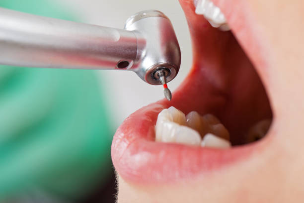 Best Emergency Dental Extractions in Lincoln, AL